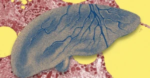 AI Is Emerging as a New Tool Against Fatty Liver Disease
